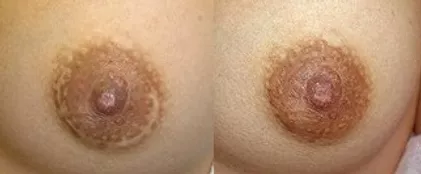 First Areola Restoration Before And After Picture
