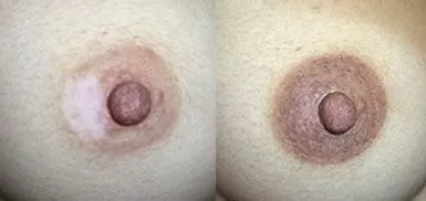 Second Areola Restoration Before And After Picture