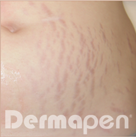 First Dermapen Before And After Picture