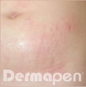 Second Dermapen Before And After Picture