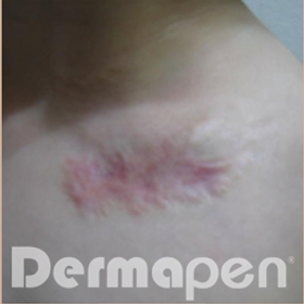 Third Dermapen Before And After Picture