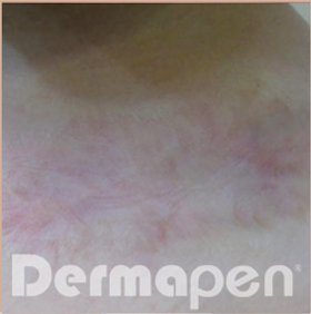 Fourth Dermapen Before And After Picture