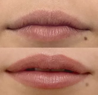 First Lips Before And After Picture