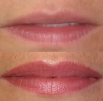 Second Lips Before And After Picture