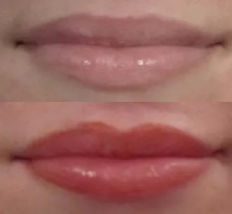 Third Lips Before And After Picture