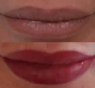 Fourth Lips Before And After Picture