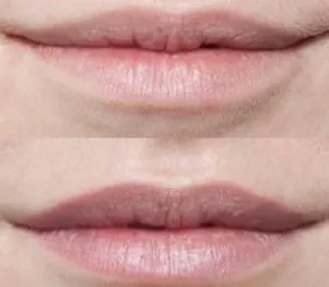 Fifth Lips Before And After Picture