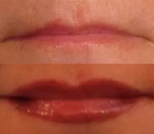Sixth Lips Before And After Picture