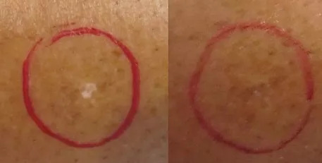 First Scar Correction Before And After Picture