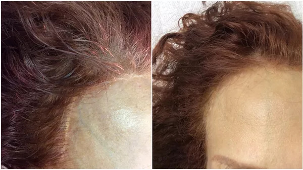 Third Scar Correction Before And After Picture